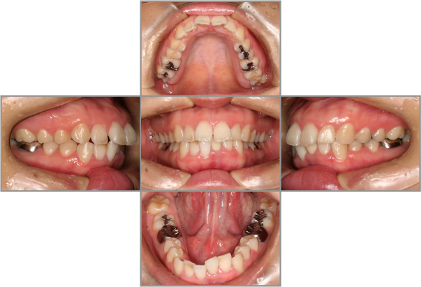 矯正治療前 Bi-Maxillary protrusion(上下突出)