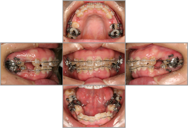 矯正治療中 Bi-Maxillary protrusion(上下突出)