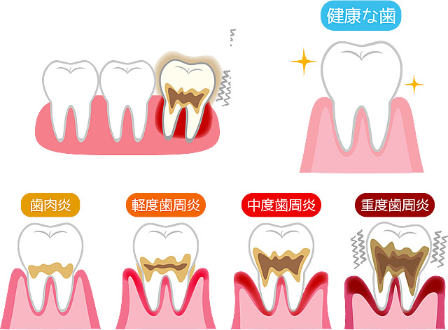 歯周病治療